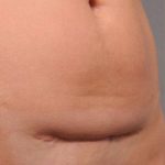 Scar Revision Before & After Patient #1071