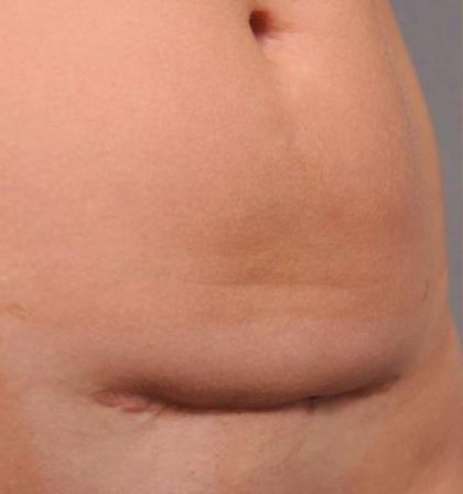 Scar Revision Before & After Patient #1071