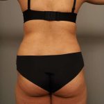 Scarless Rib Contouring (RibXcar) Before & After Patient #1103