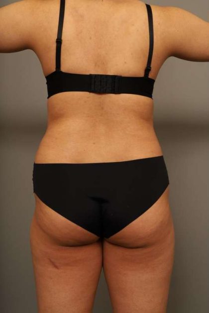 Scarless Rib Contouring (RibXcar) Before & After Patient #1103