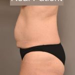 Tummy Tuck Before & After Patient #296