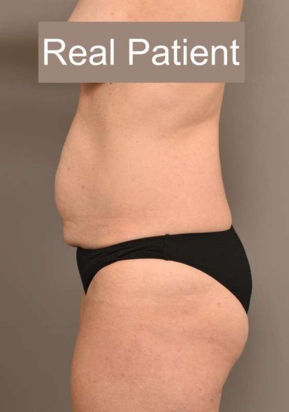 Tummy Tuck Before & After Patient #296