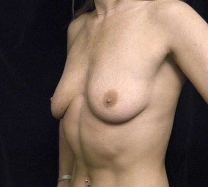 Under The Muscle Breast Augmentation Before & After Patient #1157