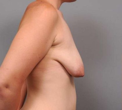 Breast Lift Before & After Patient #1202