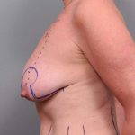 Breast Lift Before & After Patient #1221