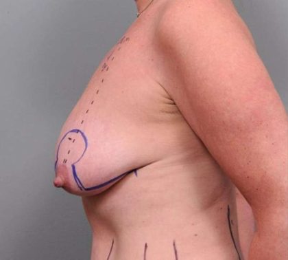 Breast Lift Before & After Patient #1221