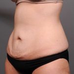 Tummy Tuck Before & After Patient #411