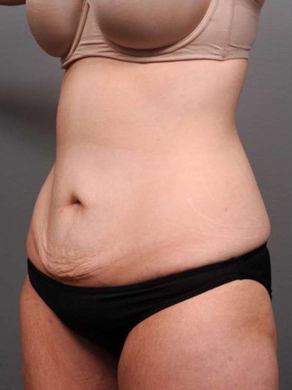Tummy Tuck Before & After Patient #411