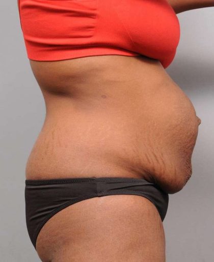 Tummy Tuck Before & After Patient #427