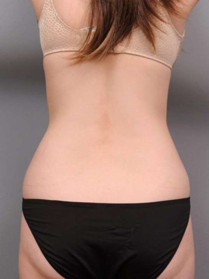 Tummy Tuck Before & After Patient #436