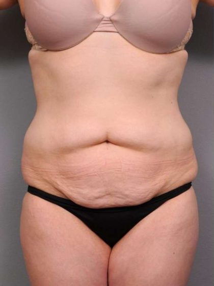 Tummy Tuck Before & After Patient #463