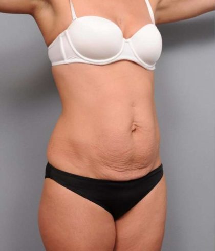 Tummy Tuck Before & After Patient #474