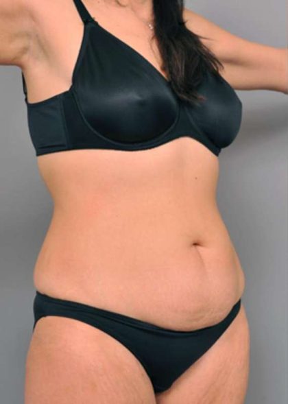 Tummy Tuck Before & After Patient #515