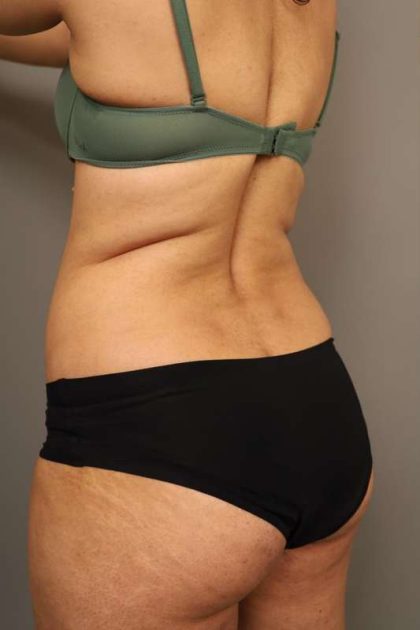 Liposuction Before & After Patient #550