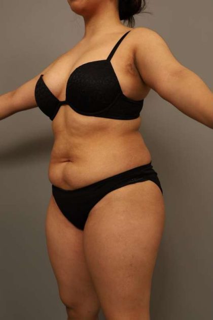 Liposuction Before & After Patient #563