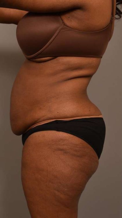 Tummy Tuck Before & After Patient #574