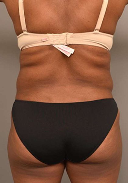Liposuction Before & After Patient #604