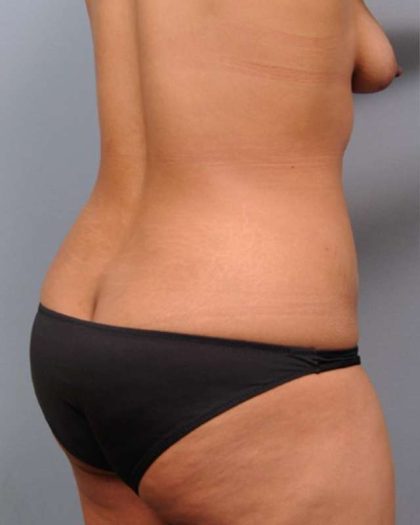 Liposuction Before & After Patient #635
