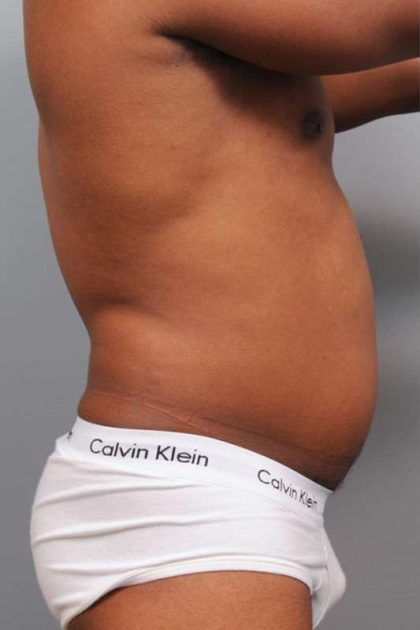 Liposuction Before & After Patient #648