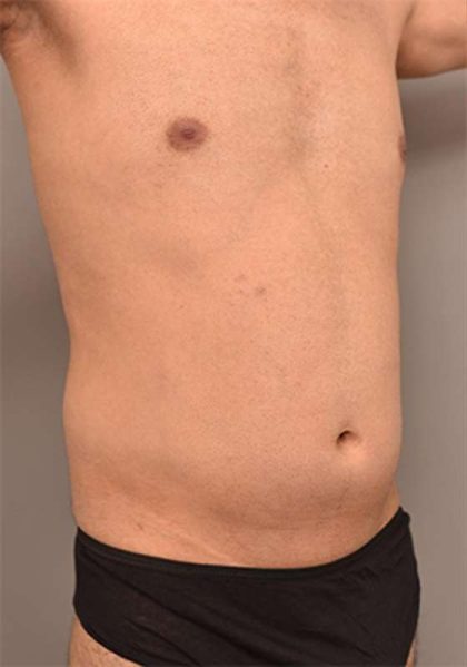 Liposuction Before & After Patient #704