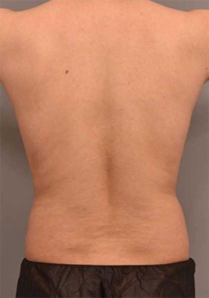 Liposuction Before & After Patient #749