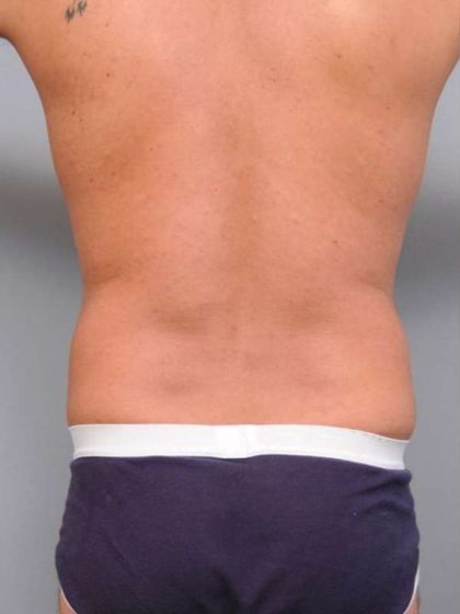 Liposuction Before & After Patient #783