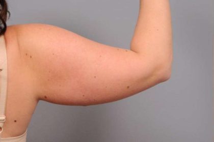 Arm Liposuction Before & After Patient #842