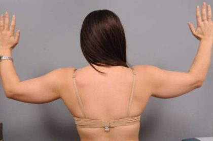Arm Liposuction Before & After Patient #851
