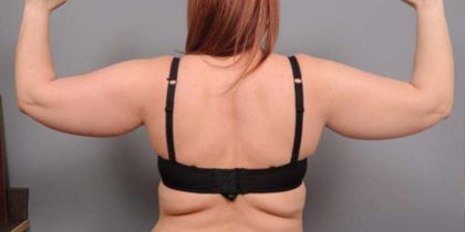Arm Liposuction Before & After Patient #872