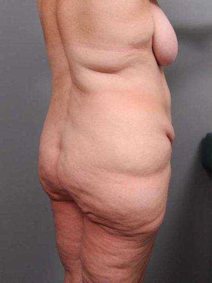 Lower Body Lift Before & After Patient #916
