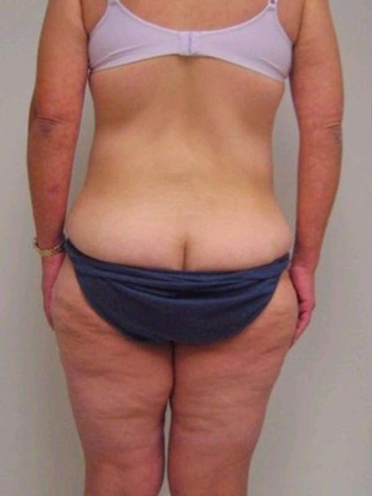 Lower Body Lift Before & After Patient #925