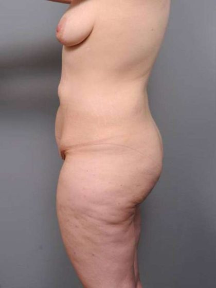 Lower Body Lift Before & After Patient #941