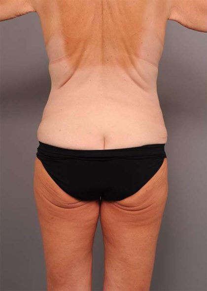 Lower Body Lift Before & After Patient #974