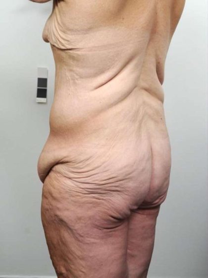 Lower Body Lift Before & After Patient #985
