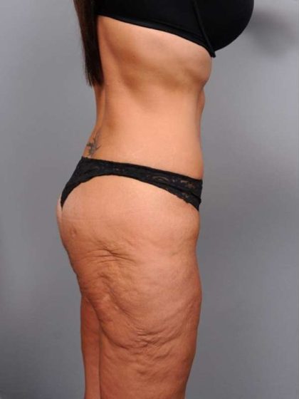 Lower Body Lift Before & After Patient #1010