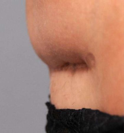 Scar Revision Before & After Patient #1071