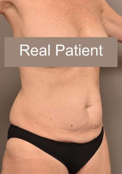 Tummy Tuck Before & After Patient #296