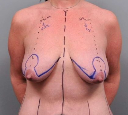 Breast Lift Before & After Patient #1221