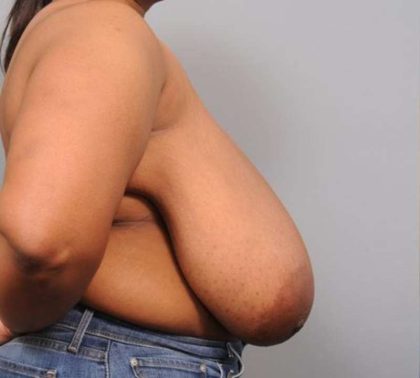 Breast Reduction Before & After Patient #1293