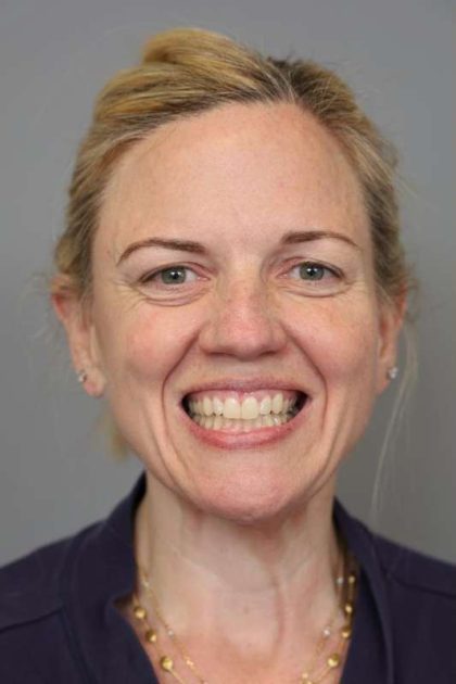 Facelift Before & After Patient #1371