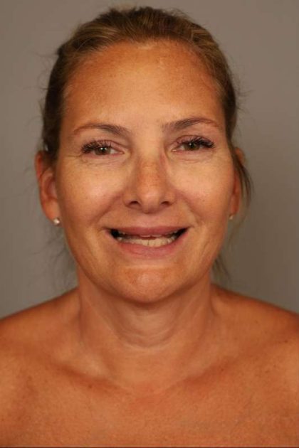 Facelift Before & After Patient #1380