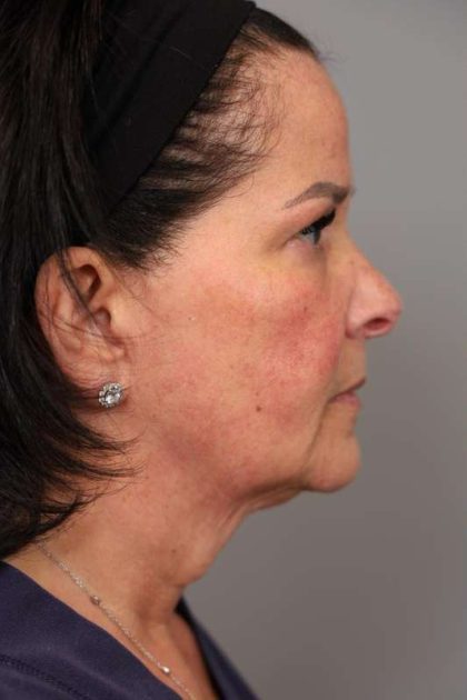 Facelift Before & After Patient #1427