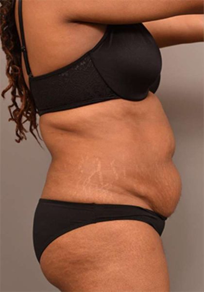 Tummy Tuck Before & After Patient #312