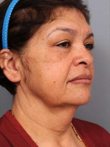 Naturalift™ Mini Facelift Before & After Patient #1452