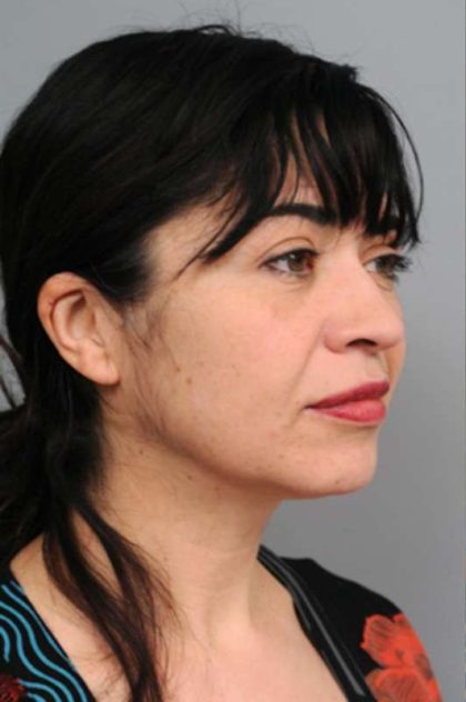 Naturalift™ Mini Facelift Before & After Patient #1474