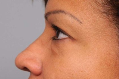 Eyelid Surgery Before & After Patient #1490