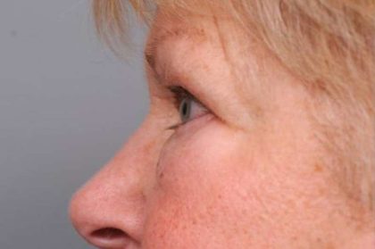 Eyelid Surgery Before & After Patient #1504