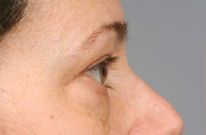 Eyelid Surgery Before & After Patient #1550