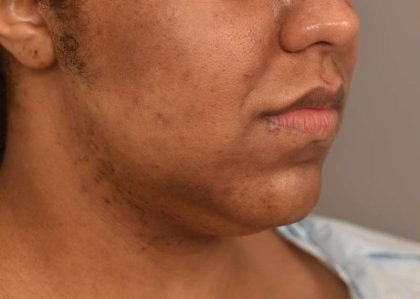 Neck Lift (Traditional) Before & After Patient #1621