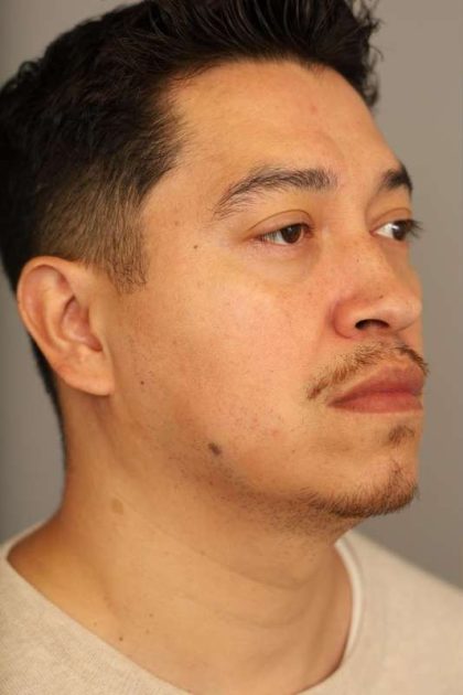 Mini Neck Lift (Single Incision) Before & After Patient #1630
